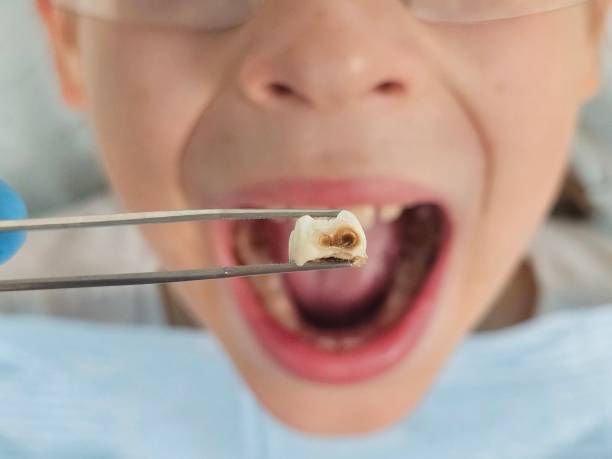 Best Emergency Treatment for Oral Infections in Deadwood, SD